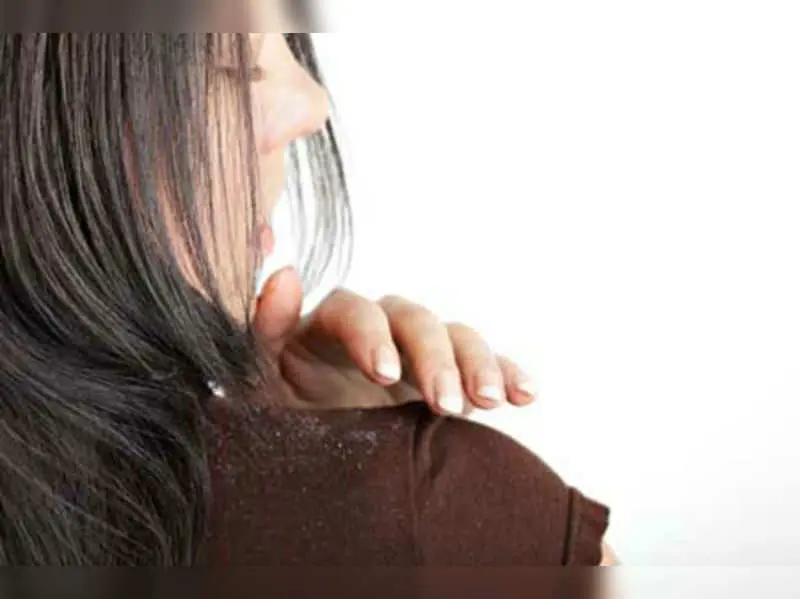 How to get rid of dandruff? 30 ways: fast, simple, effective and permanent