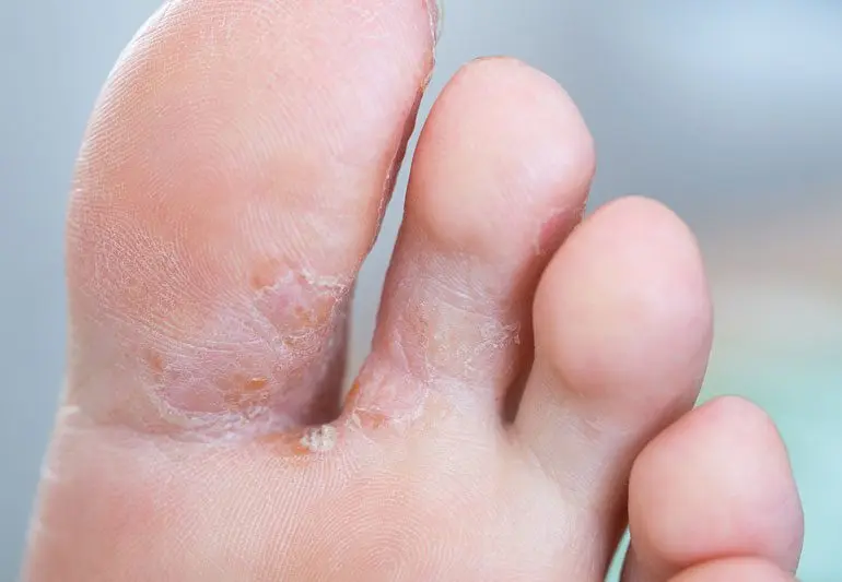 How to get rid of foot fungus