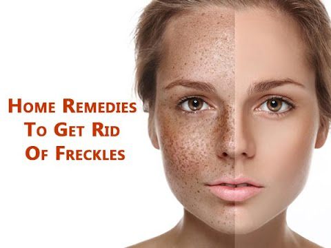 How to get rid of freckles? Video