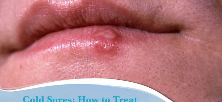 Херпес на устните: лечение. Видео