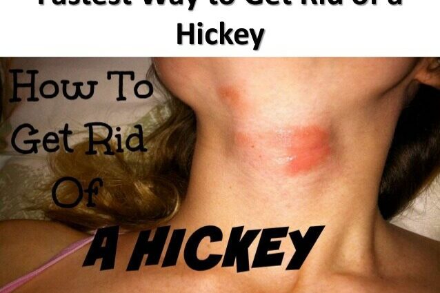 Hoe om van hickey ontslae te raak: 7 maniere wat werk
