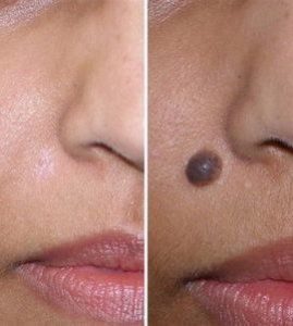 How to get rid of moles, papillomas, warts