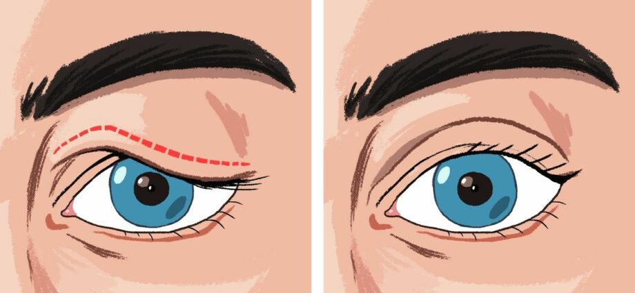 how-to-get-rid-of-saggy-eyelids-the-surgeon-answers-healthy-food-near-me