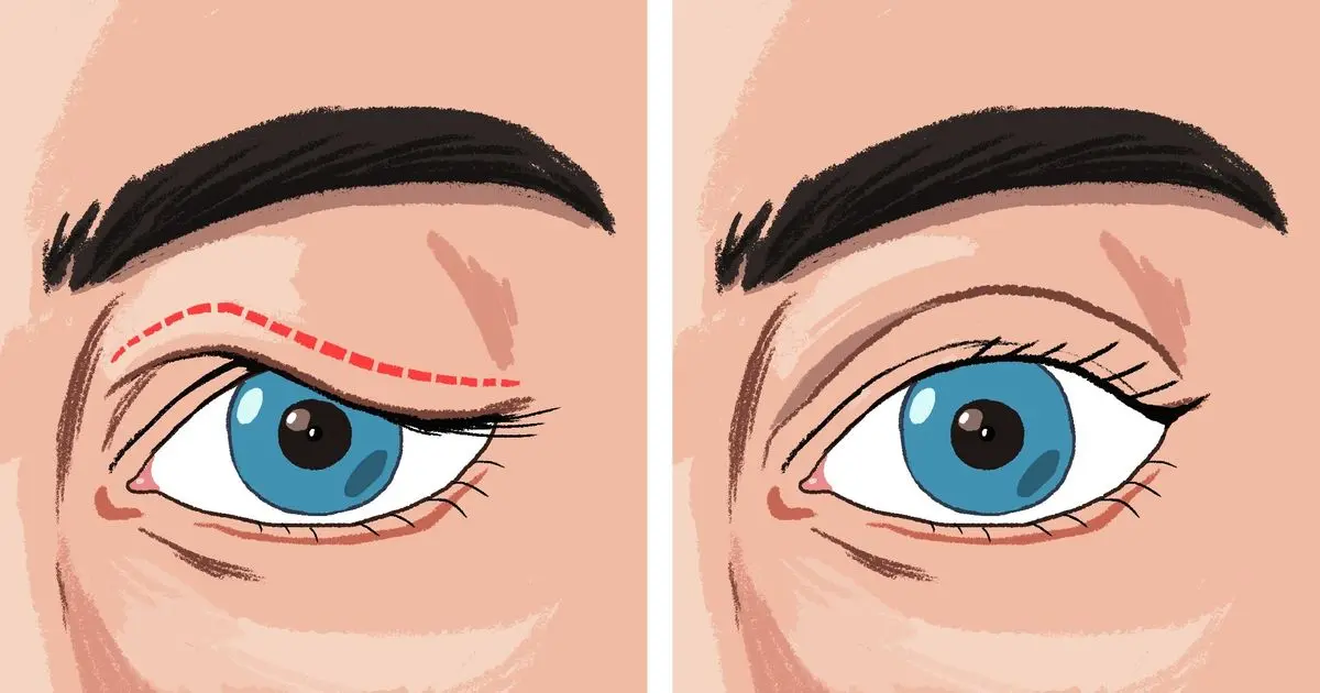 How to get rid of saggy eyelids: the surgeon answers