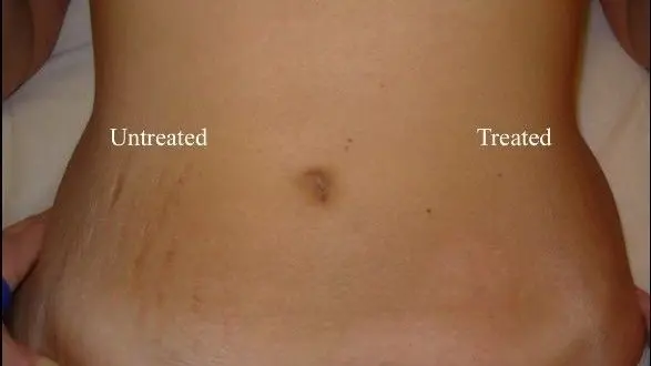 How to get rid of stretch marks in 30 minutes