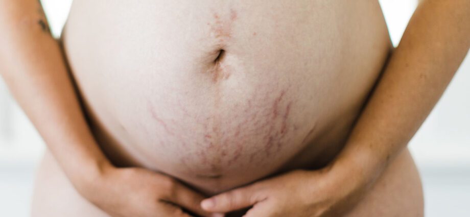 Cumu sbarrazzassi di e smagliature durante a gravidanza