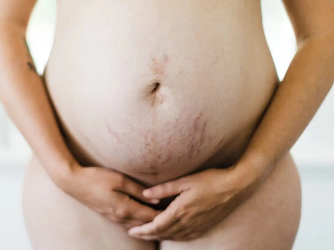 How to get rid of stretch marks during pregnancy