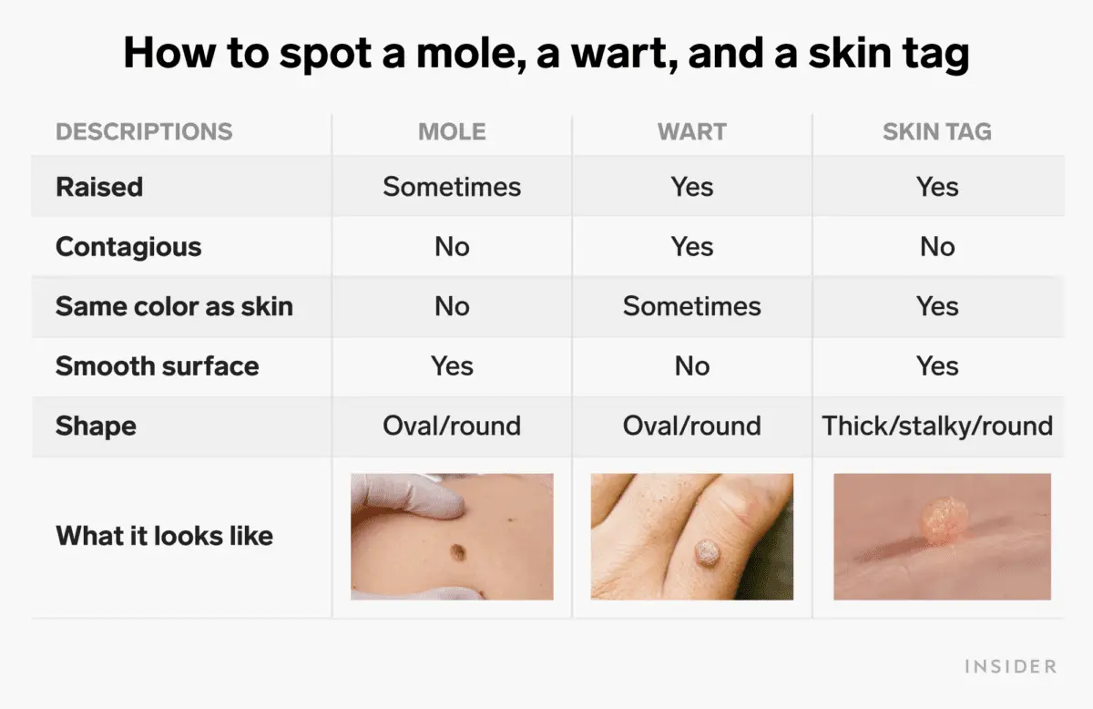 How to get rid of warts