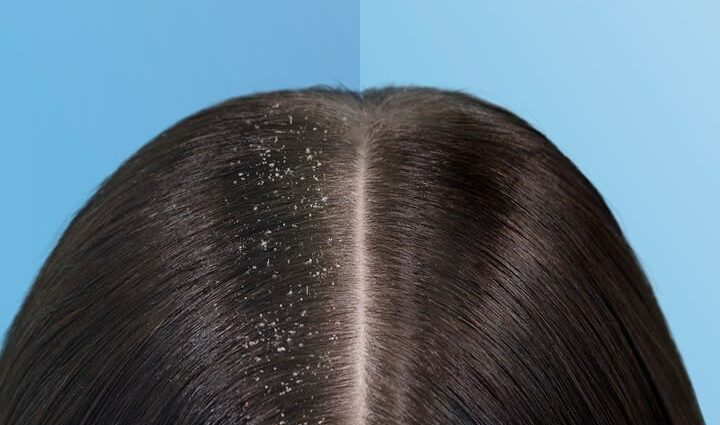 How to quickly get rid of dandruff