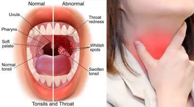 How to quickly heal a throat at home