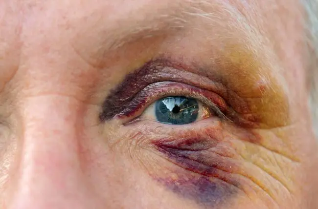 How to quickly remove swelling and black eye: advice from a beautician