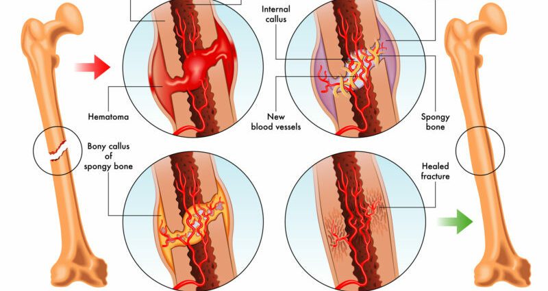 How to relieve a fracture and a sprain?