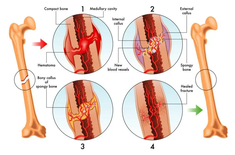 How to relieve a fracture and a sprain?