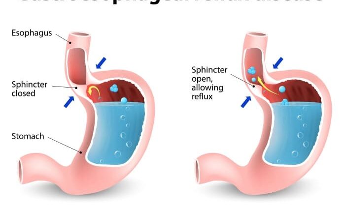 How to relieve heartburn effectively?