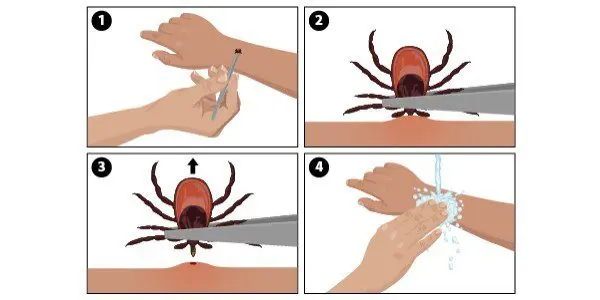 How to remove a tick at home from a person