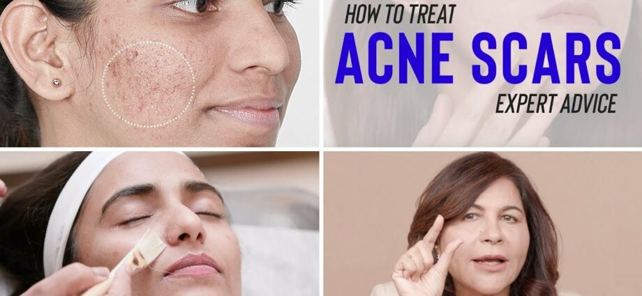 How to remove acne spots. Video