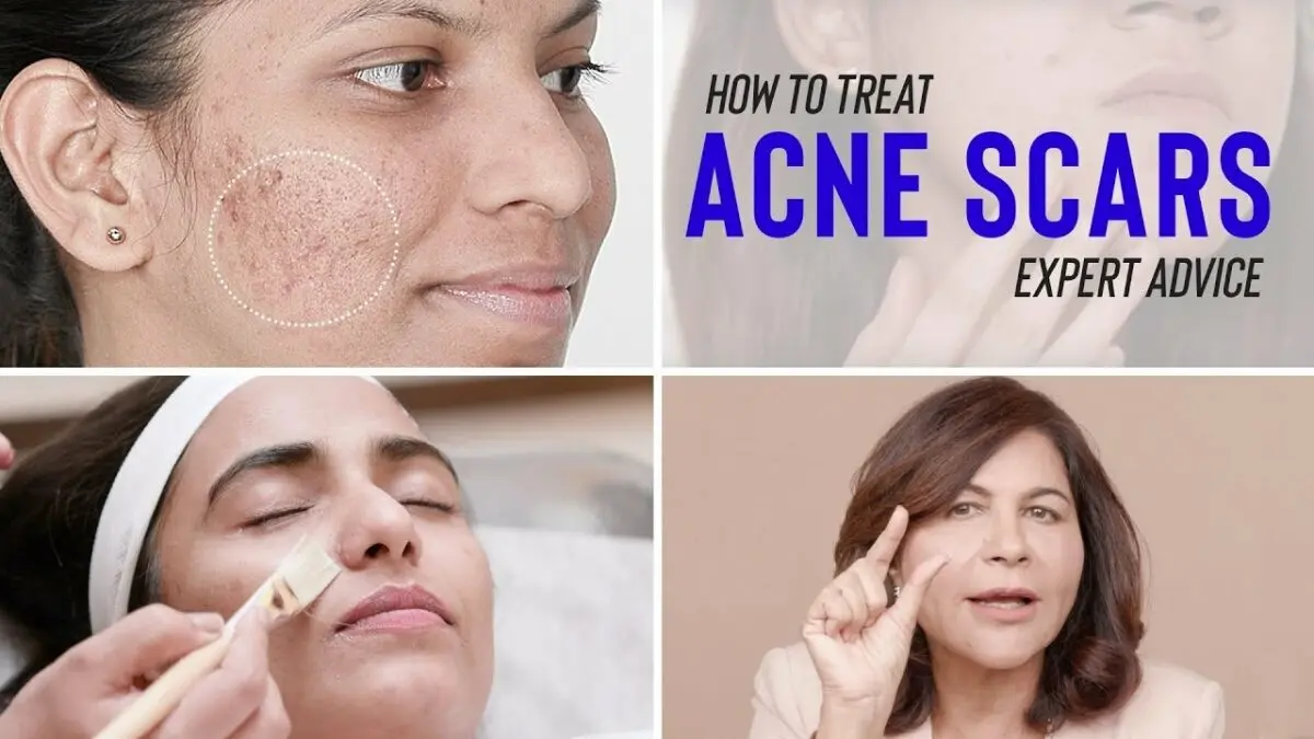 How to remove acne spots. Video