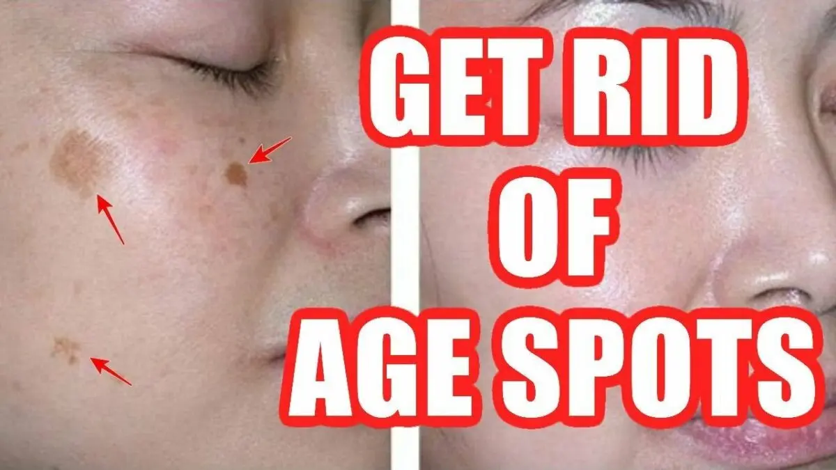 How to remove age spots