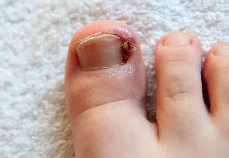 How to remove an ingrown toenail without pain