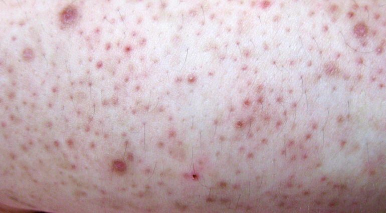 How to remove annoying pimples on arms and feet that look like acne but are not