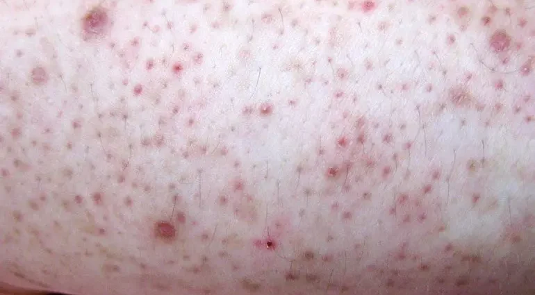 How to remove annoying pimples on arms and feet that look like acne but are not