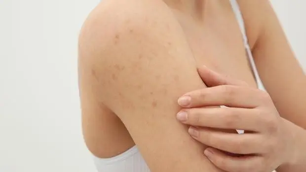 How to remove annoying pimples on arms and feet that look like acne but are not