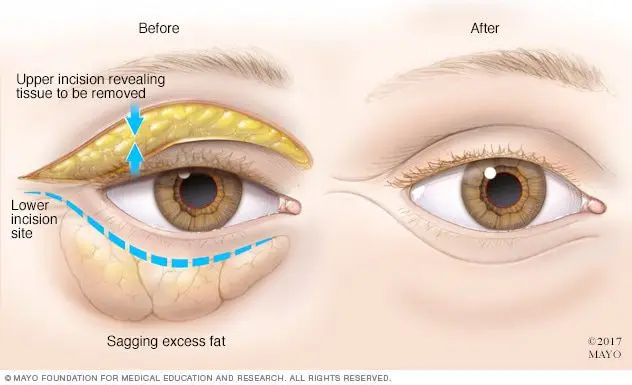 How to remove bags under the eyes. Video