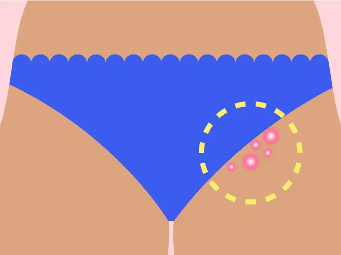 How to remove irritation in the bikini area