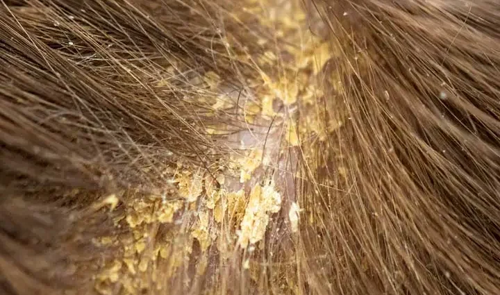 How to remove seborrheic crusts on a baby&#8217;s head? Video