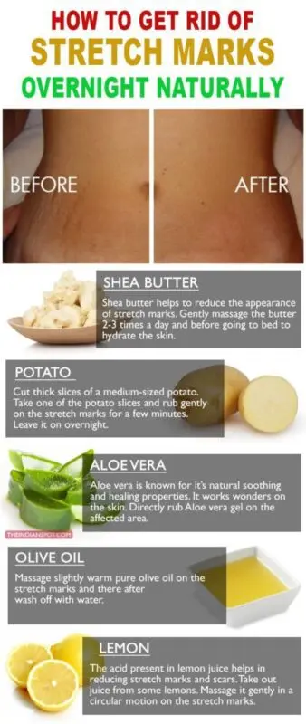 How to remove stretch marks with home remedies, recipes for stretch marks creams