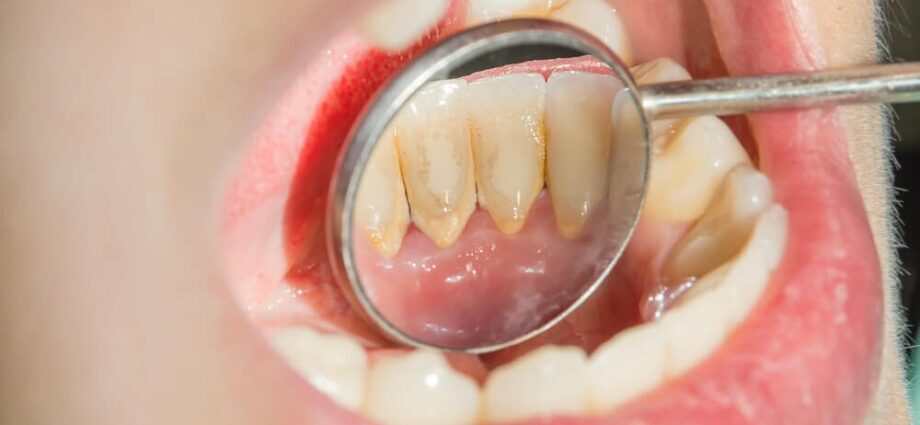 How to remove tartar: clean your teeth carefully