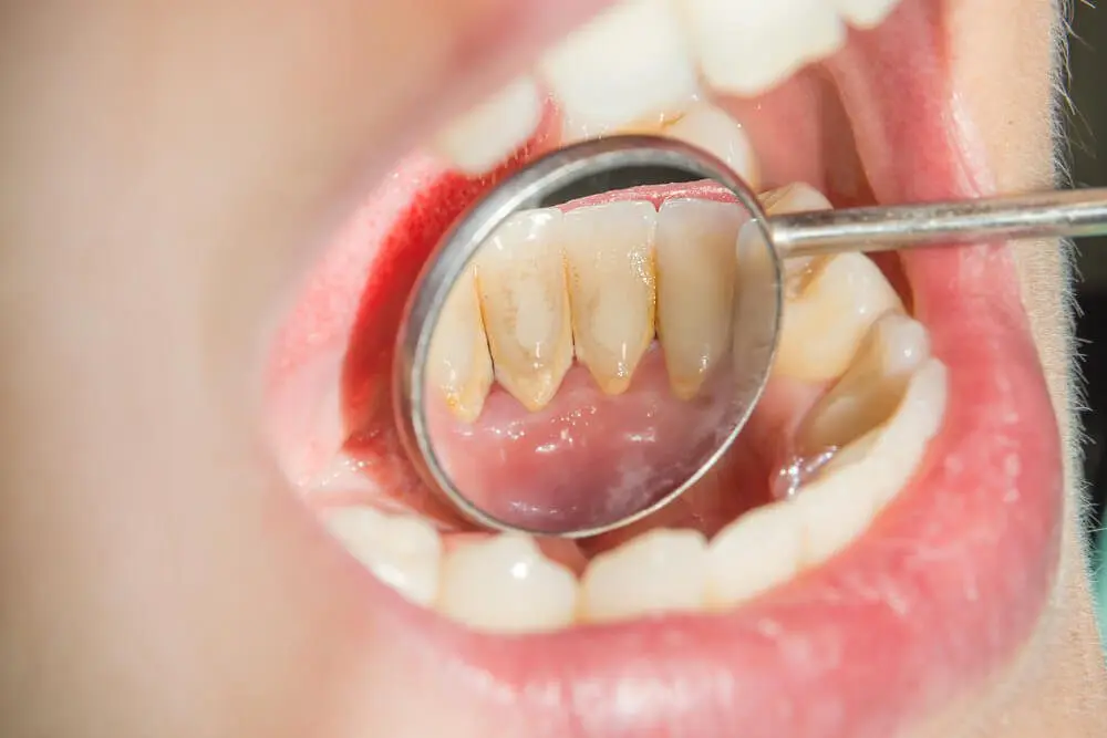 How to remove tartar: clean your teeth carefully