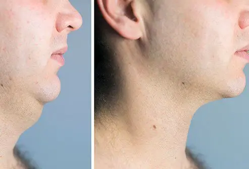 How to remove the second chin