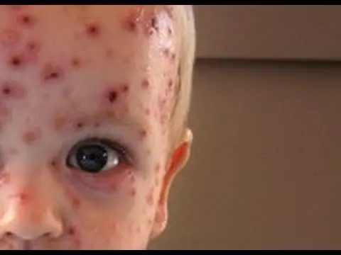 How to remove traces of chickenpox. Video