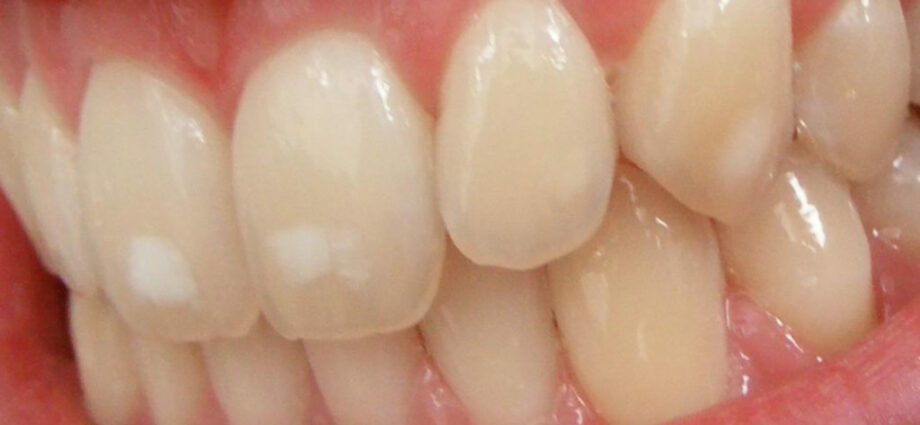 How to remove white spots on teeth?