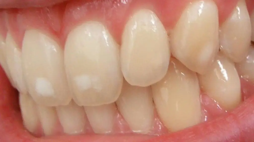 How to remove white spots on teeth?