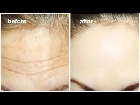 How to remove wrinkles on the forehead at home