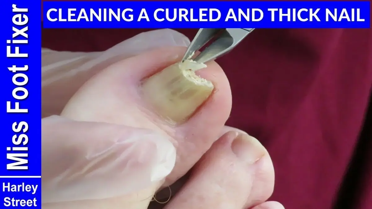 How to soften a toenail? Video advice