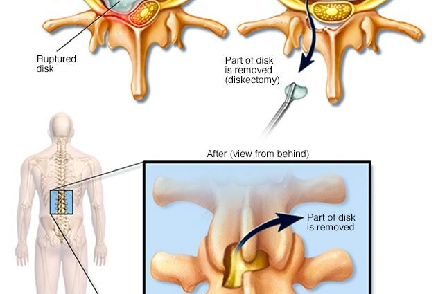 Medical treatments for a herniated disc
