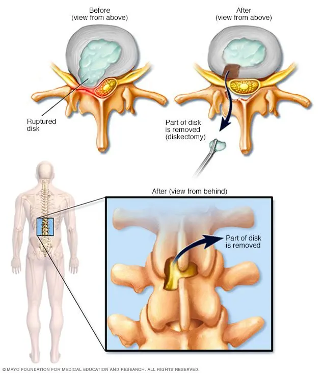 Medical treatments for a herniated disc