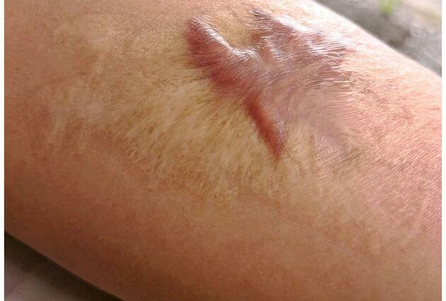 How to treat a scar?