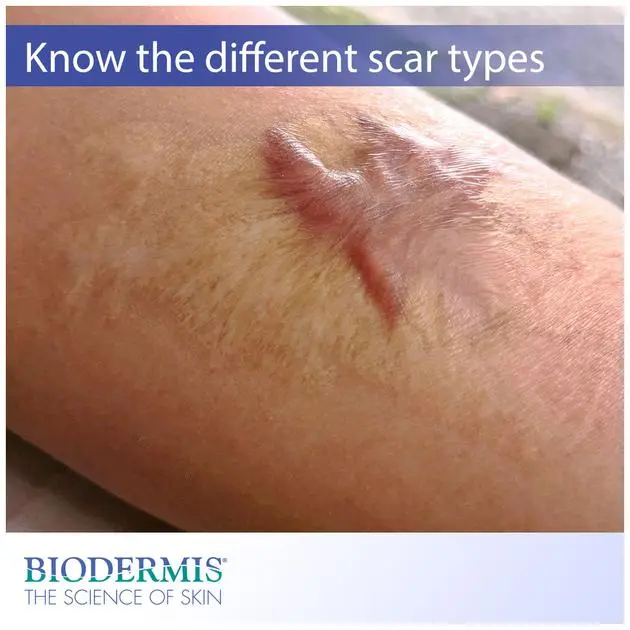 How to treat a scar?