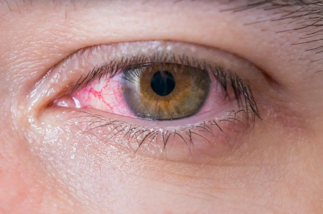 How to treat conjunctivitis?