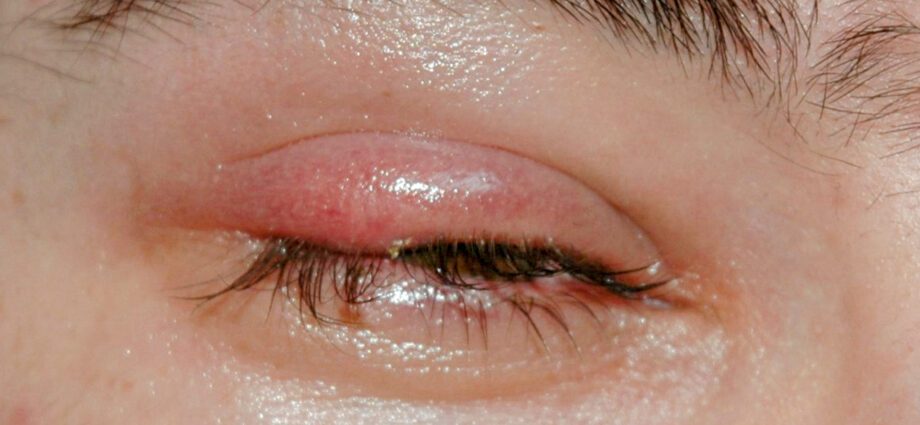 How to treat stye in the eye? Video