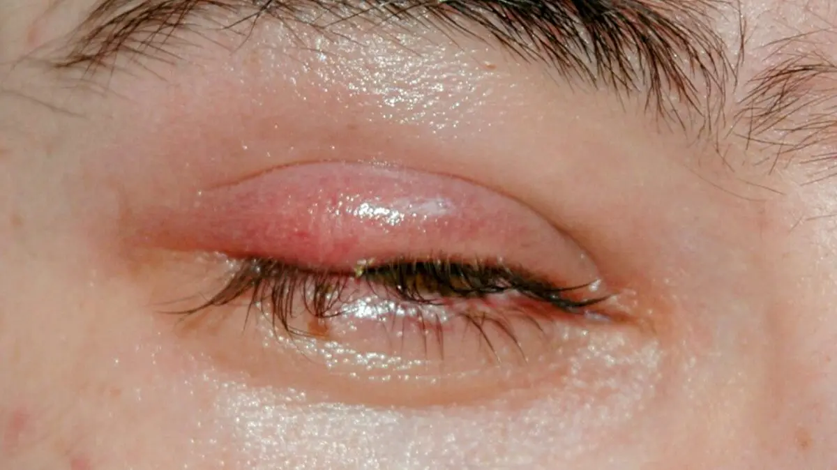 How to treat stye in the eye? Video