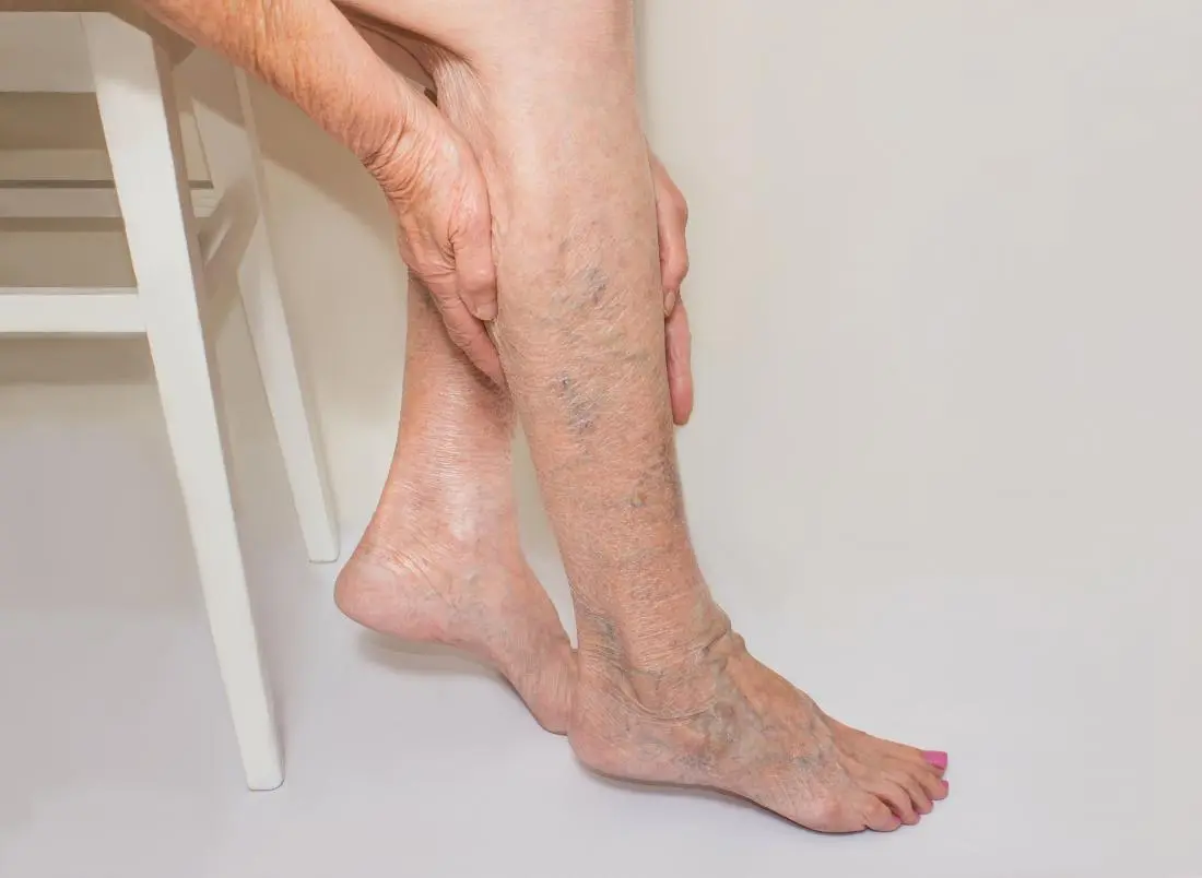 How to treat varicose veins on the legs