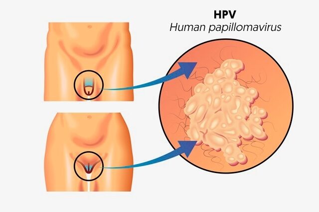 Human papillomavirus: symptoms and treatment