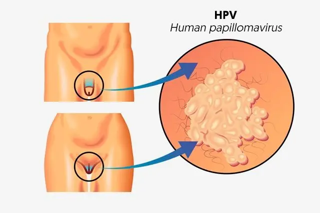 Human papillomavirus: symptoms and treatment