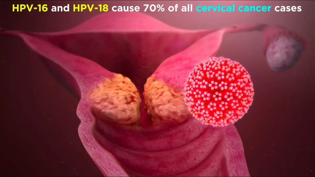 Human papillomavirus. Video