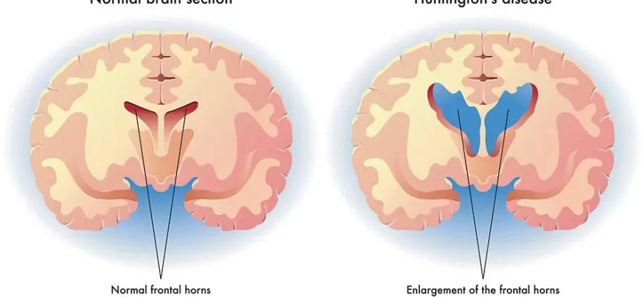 Huntington&#8217;s disease